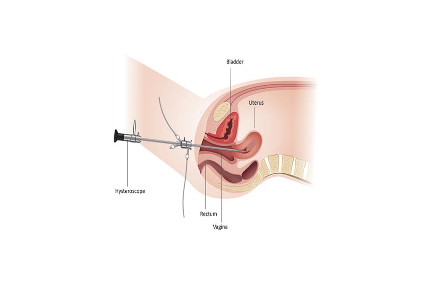 Hysteroscopy Image